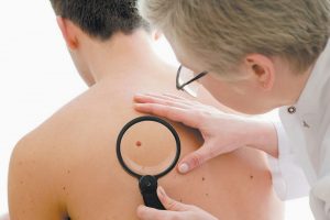 Wajib Diketahui, Ini 5 Gejala Awal Kanker Kulit