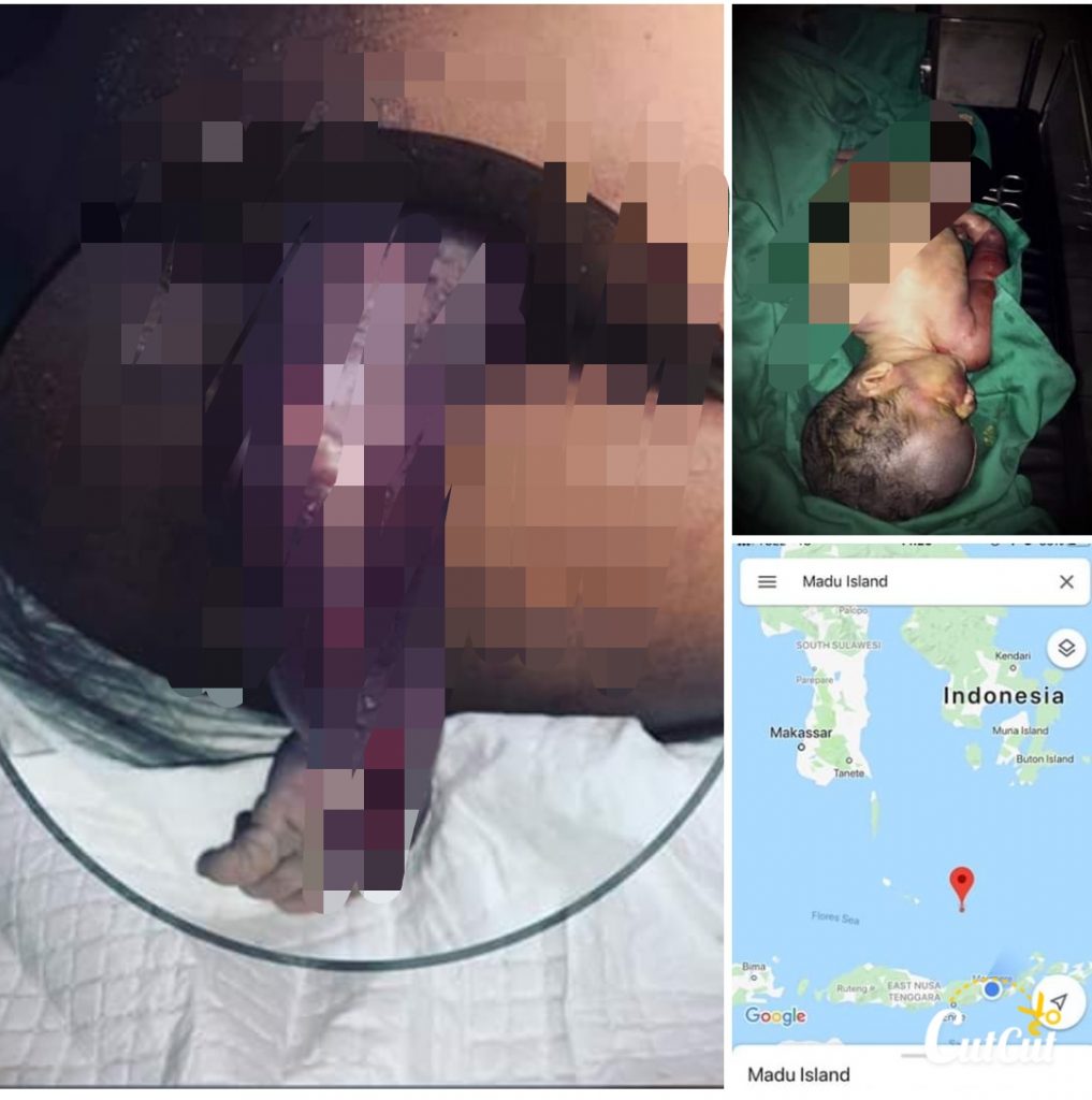 Kisah Pilu Ibu Hamil dari Sulawesi Naik Kapal Kayu Cari RS Sampai di Flores, Bayi Meninggal