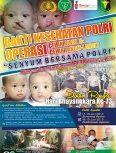 Polda NTT Segera Gelar Operasi Bibir Sumbing Gratis