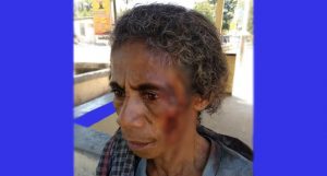 Perempuan 50 Tahun di Kupang Babak Belur Dianiaya Tetangganya