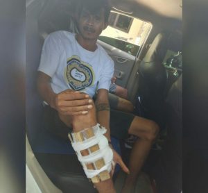 Dikeroyok, Mahasiswa di Kupang Ini Patah Kaki
