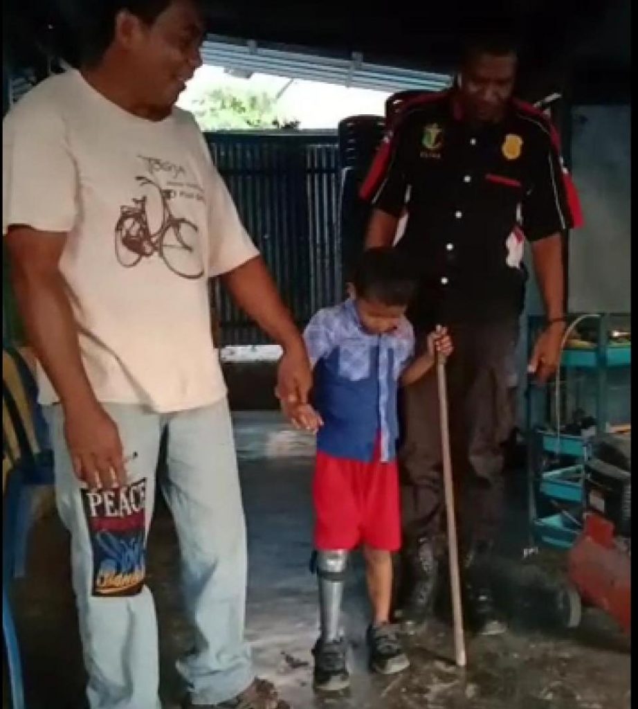 Peduli Kondisi Bocah Satu Kaki di Kupang, Kapolda NTT Berikan Kaki Palsu
