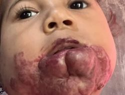 Dirut Bank NTT Bantu Biaya Pengobatan Bocah Penderita Hemangioma di Kupang